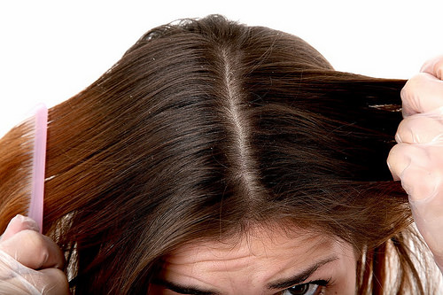 Natural Home Remedies for Dandruff